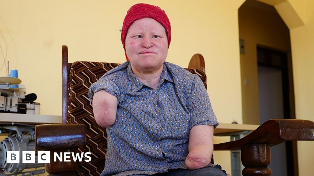 The fears that voting time brings for those with albinism The fears that voting time brings for those with albinism